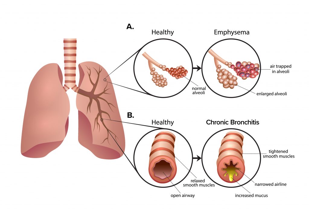 Chronic-Bronchitis_