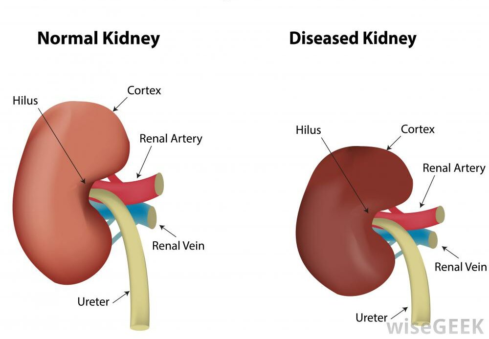 kidney disease caused by silica dust