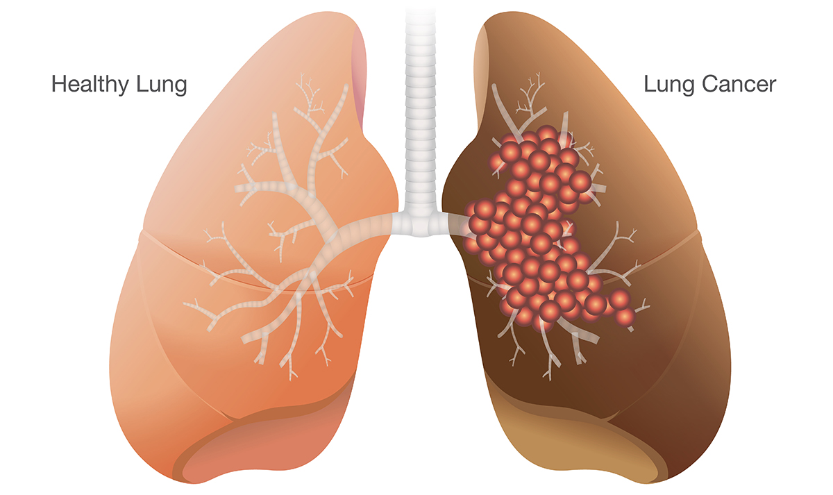 lung-cancer silica dust